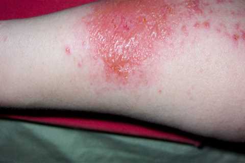 Are poison ivy rashes contagious?