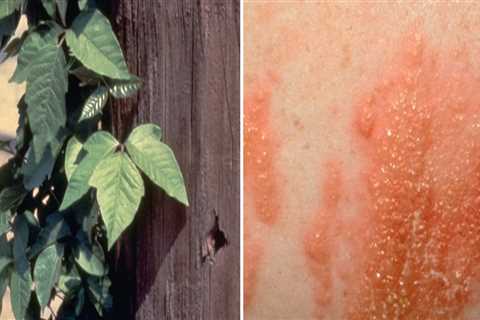 What can be mistaken for poison ivy rash?